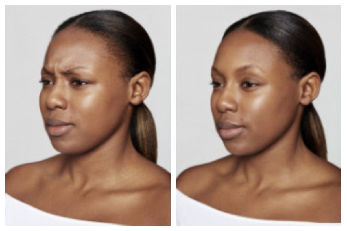 Neurotoxin - Dysport - Before & After