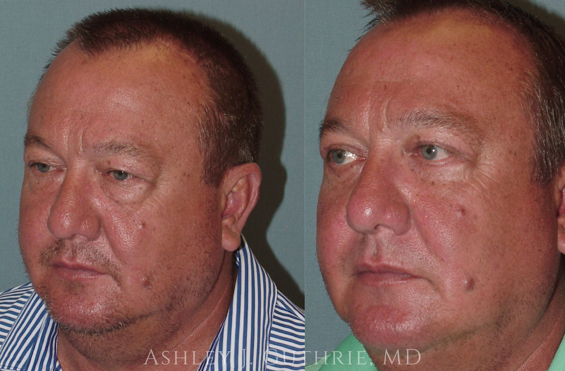 Before and After Upper and Lower Blepharoplasty