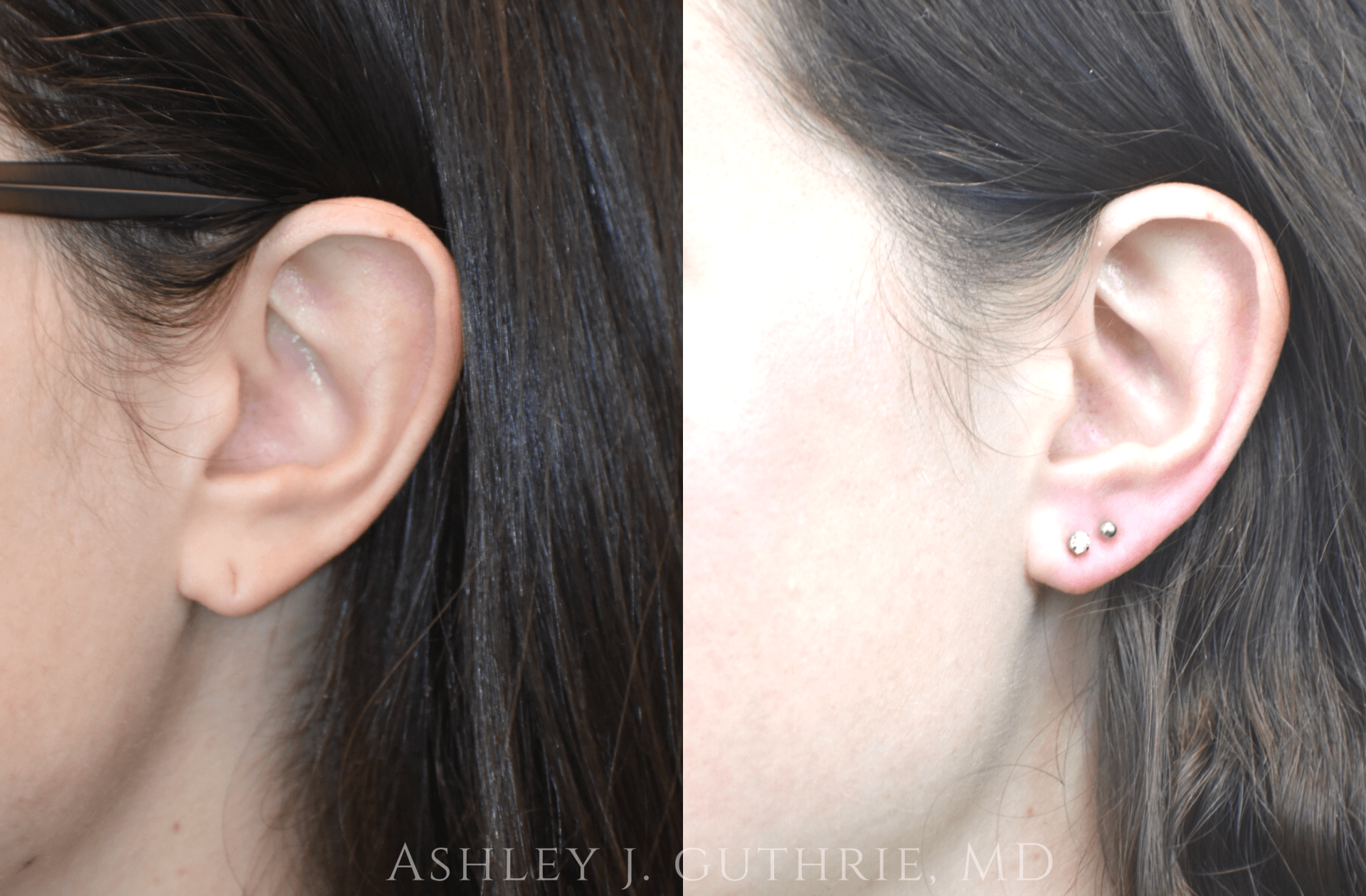 Before and After Earlobe Repair