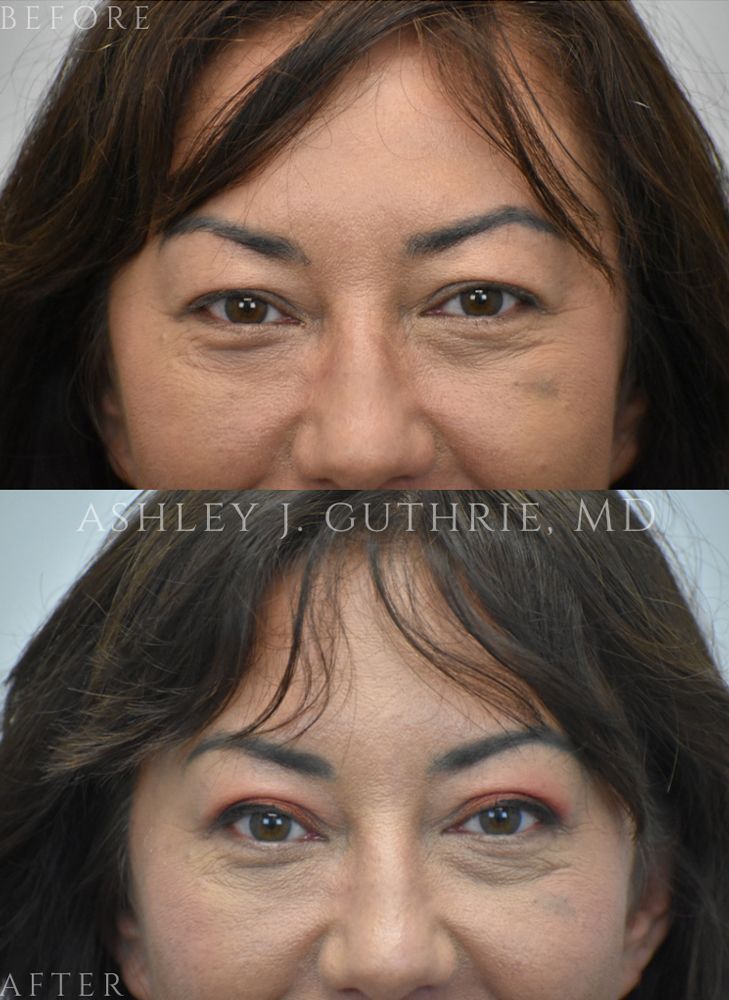 Before and After Upper Blepharoplasty