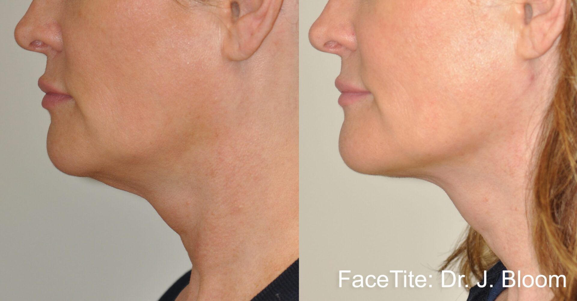 facial contouring - before and after