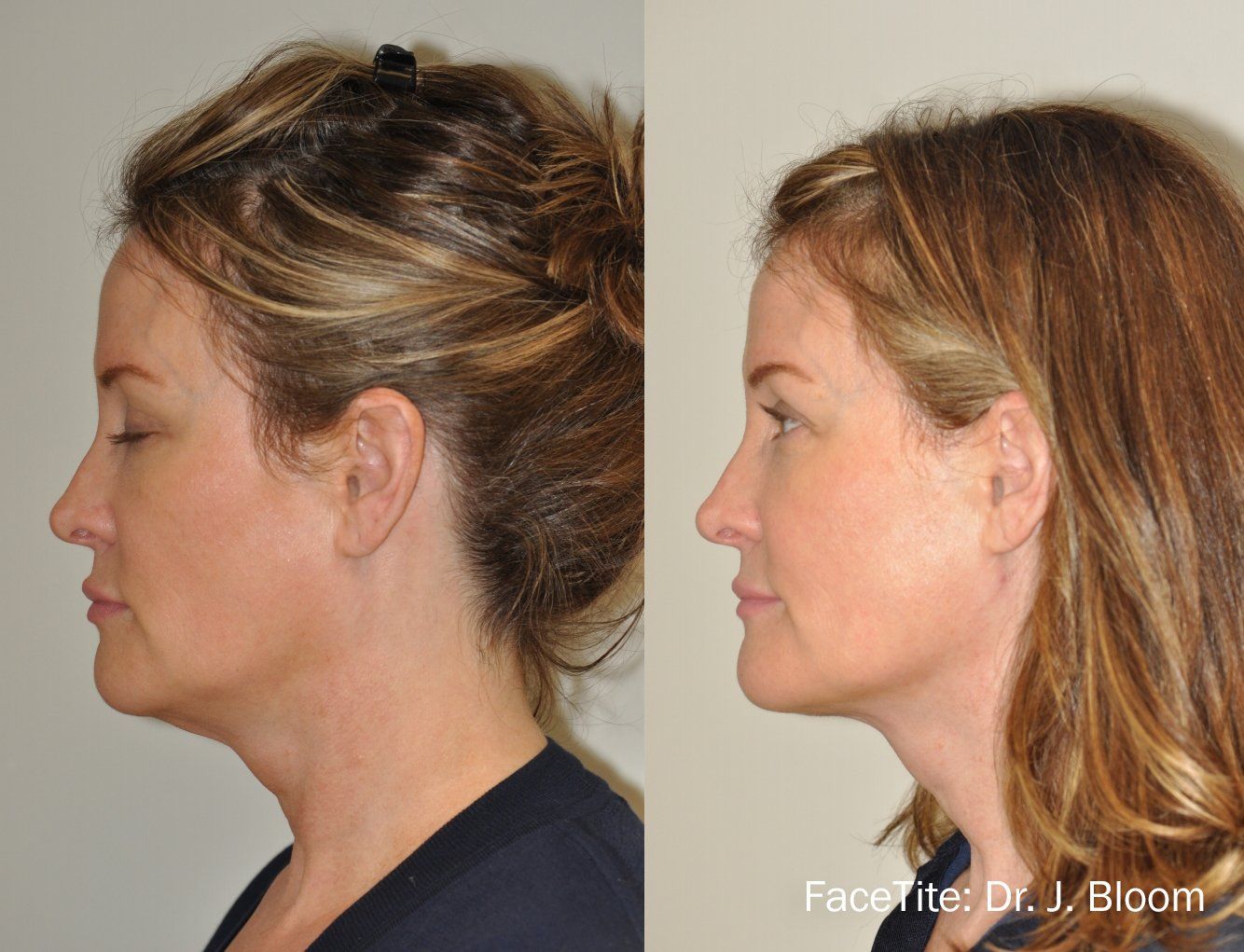 facial contouring - before and after