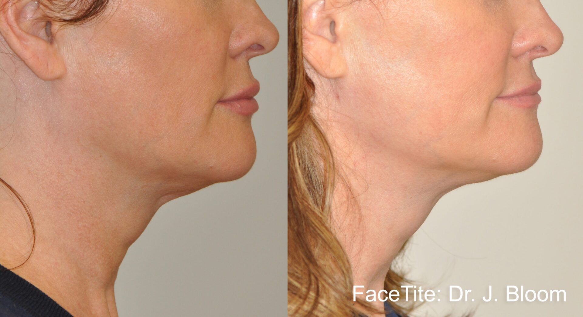 facial contouring - before and after