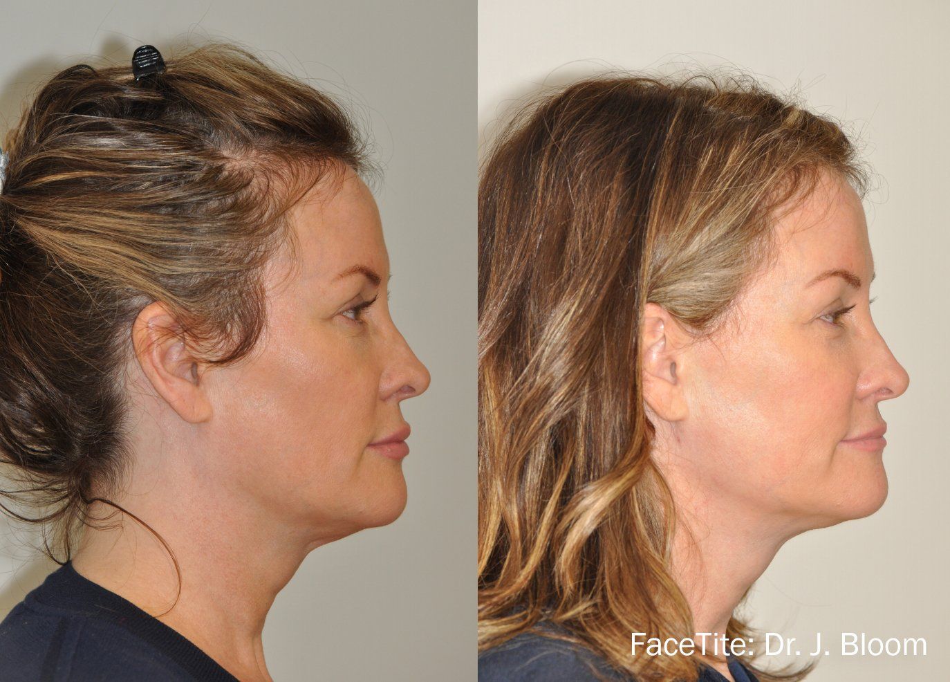 Before and After FaceTite Treatment