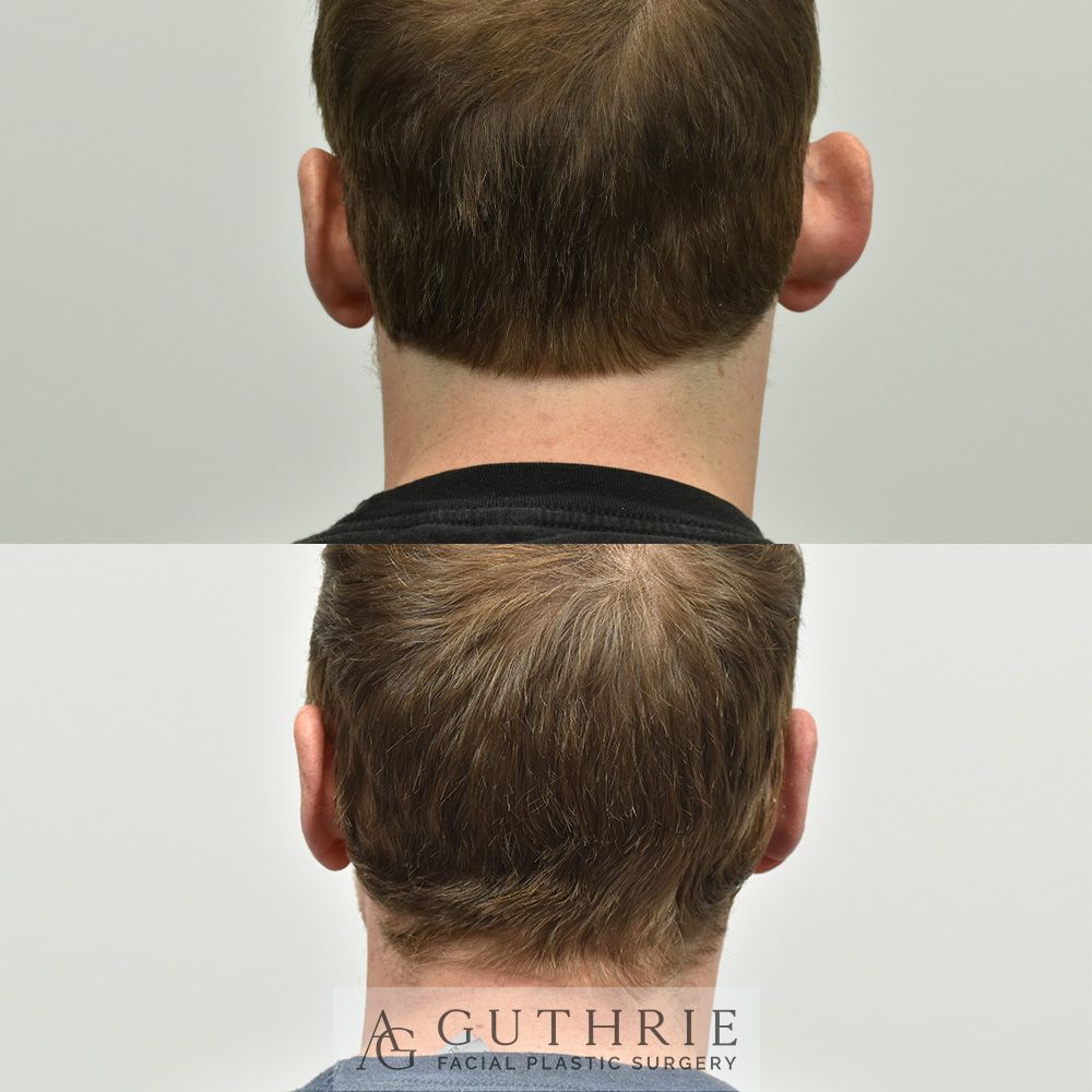 a before and after photo of a man 's face after otoplasty procedure