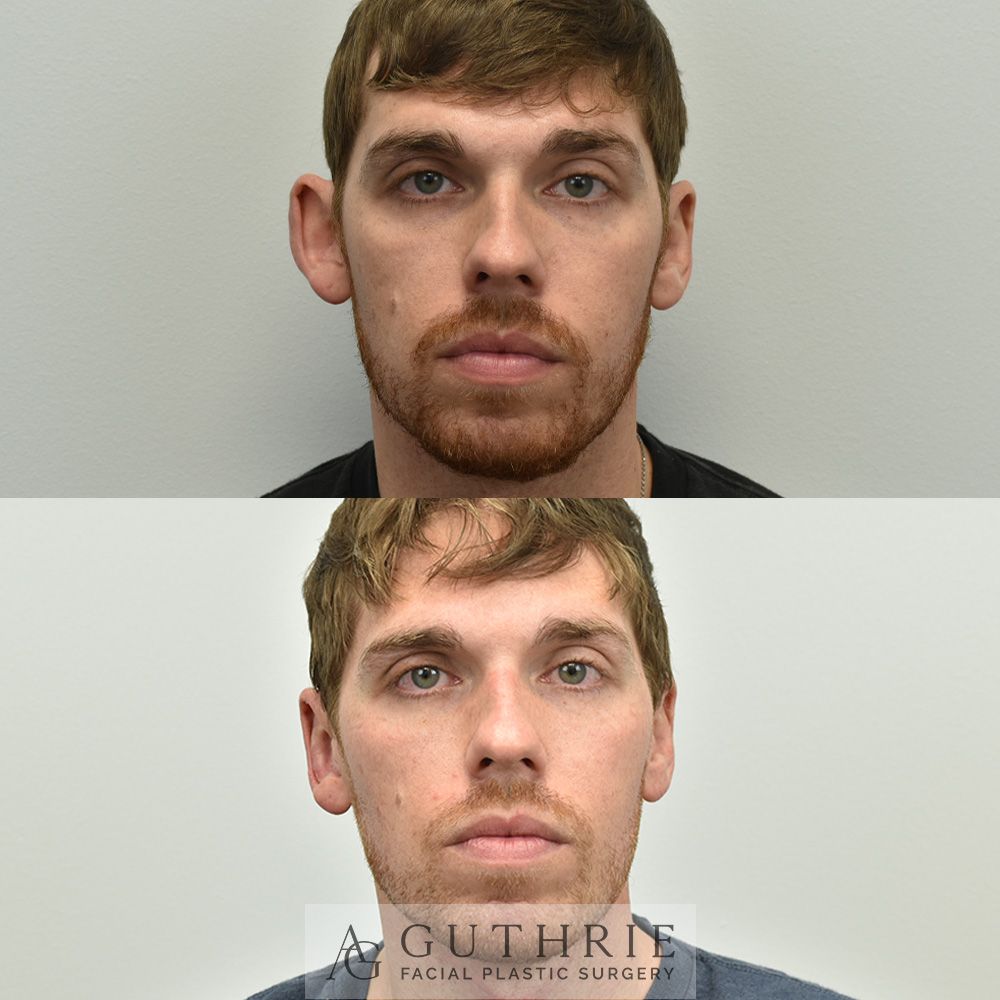 Before and After Otoplasty