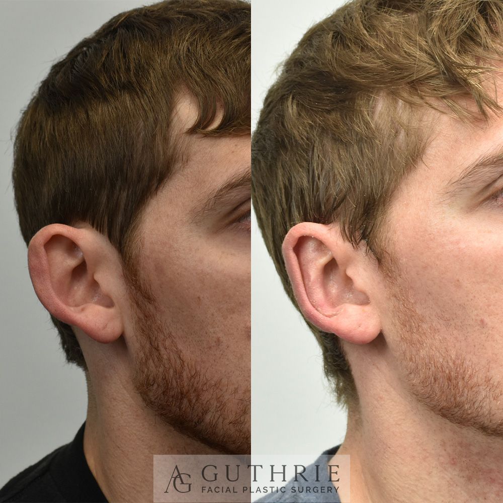 a before and after photo of a man 's face after otoplasty procedure