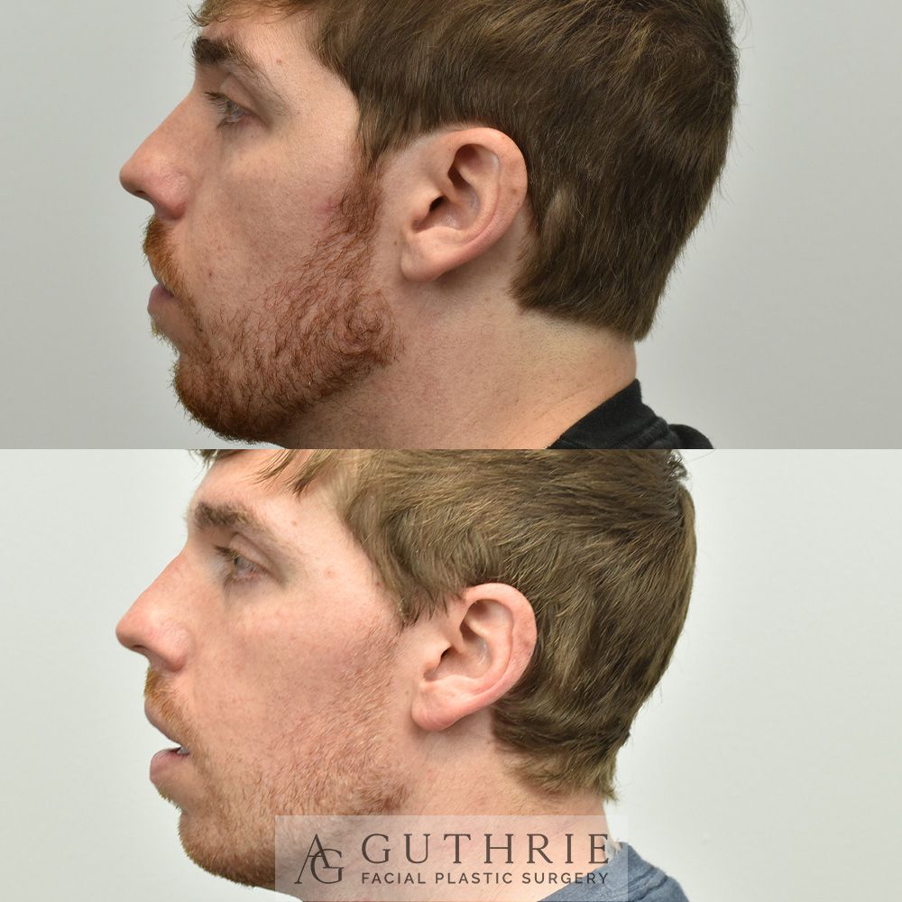 a before and after photo of a man 's face after otoplasty procedure