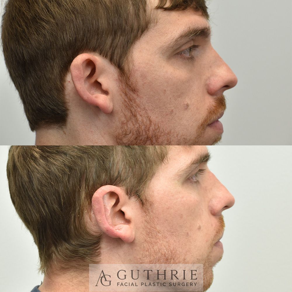 a before and after photo of a man 's face after otoplasty procedure