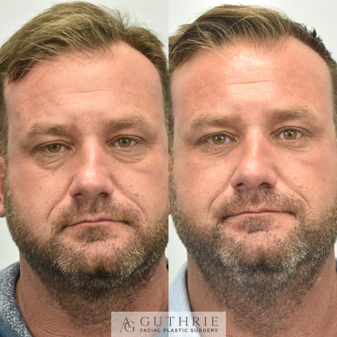Before and After Lower Blepharoplasty with Fat Transfer and CO2 Laser Resurfacing