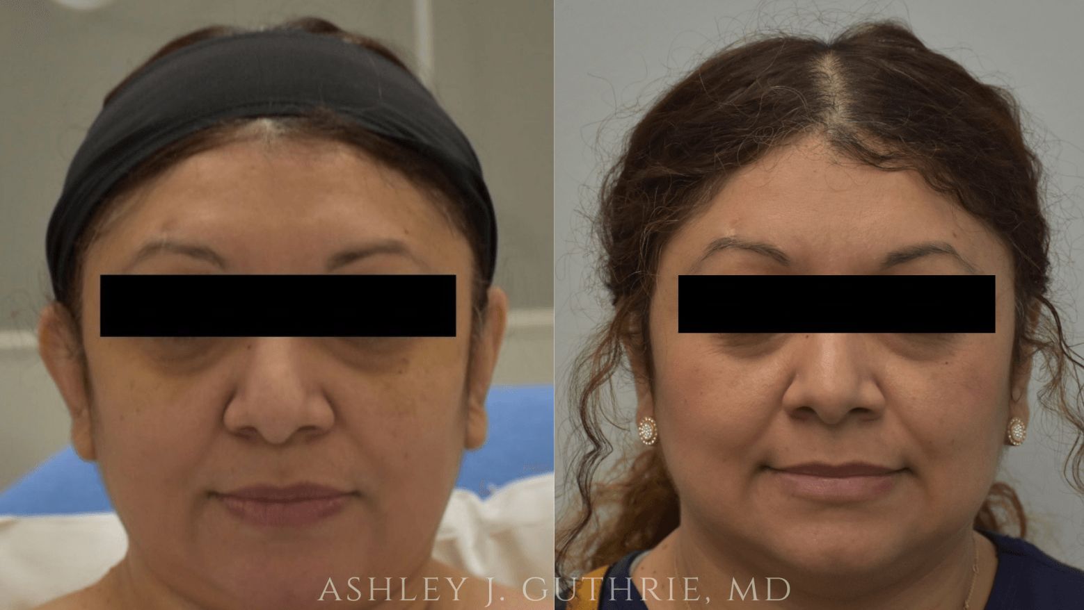 Before and After Otoplasty