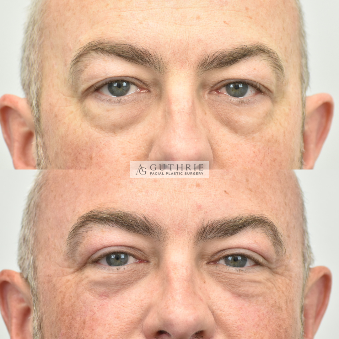 Before and After Upper and Lower Blepharoplasty