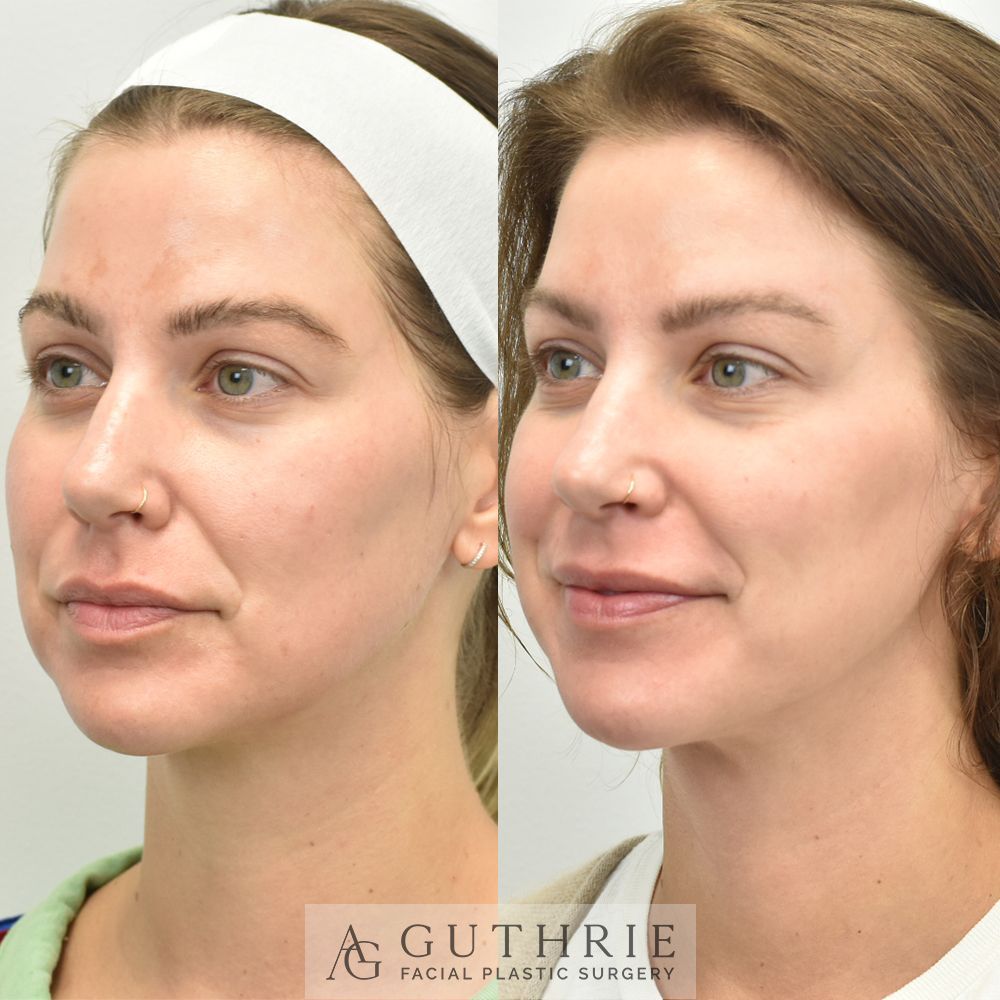 Before and After Series of 3 CoolPeel Treatments, in combination with Medical-Grade Skincare Regimen