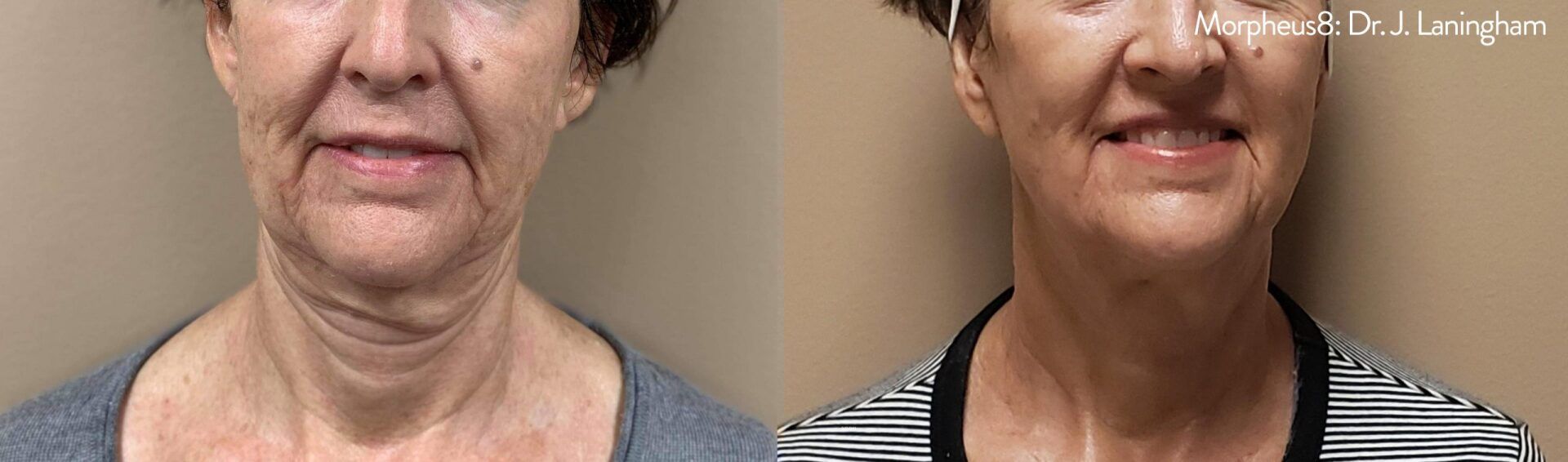 mature female patient before and after Morpheus8 face contouring treatment