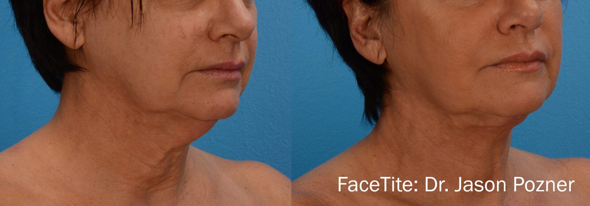 Before and After FaceTite Treatment