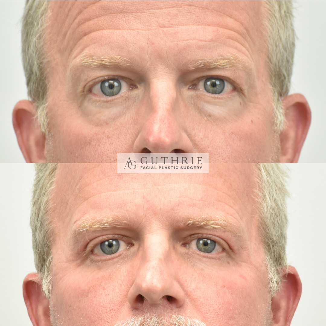 Before and After Upper and Lower Blepharoplasty and Endoscopic Brow Lift