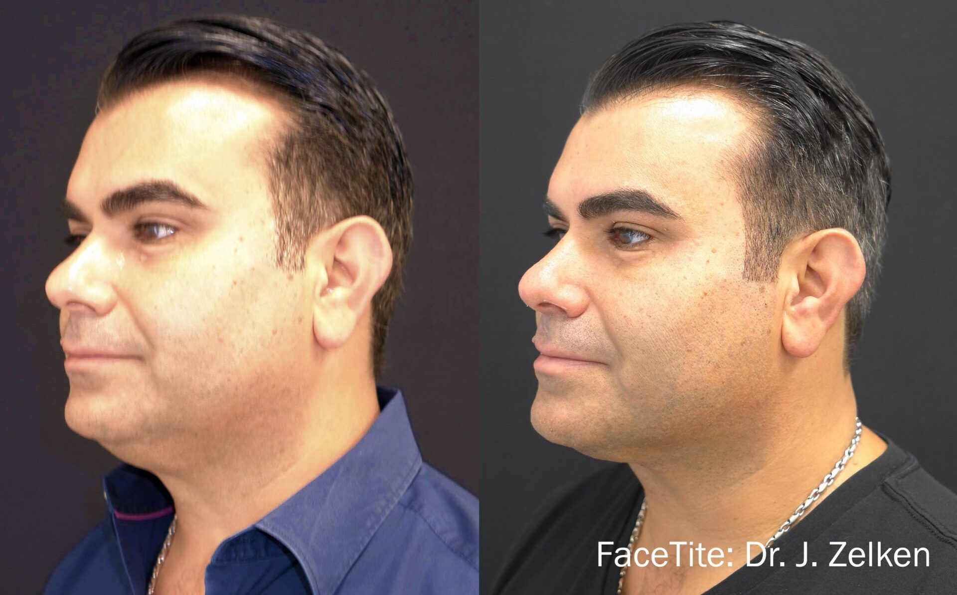 Before and After FaceTite Treatment