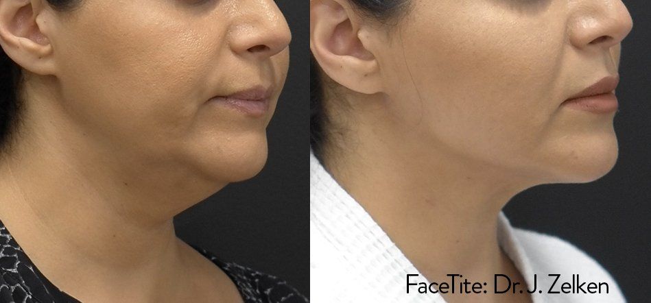 Before and After FaceTite Treatment