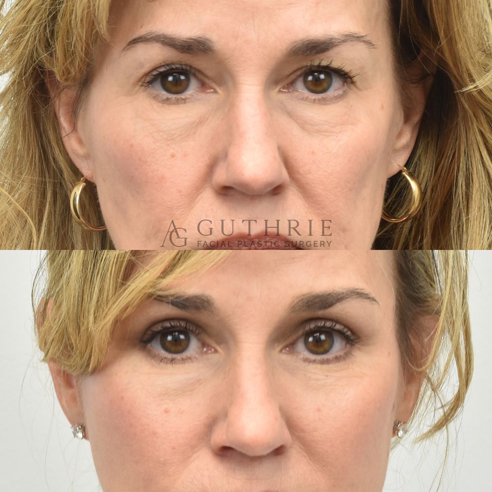 Before and After Upper Blepharoplasty