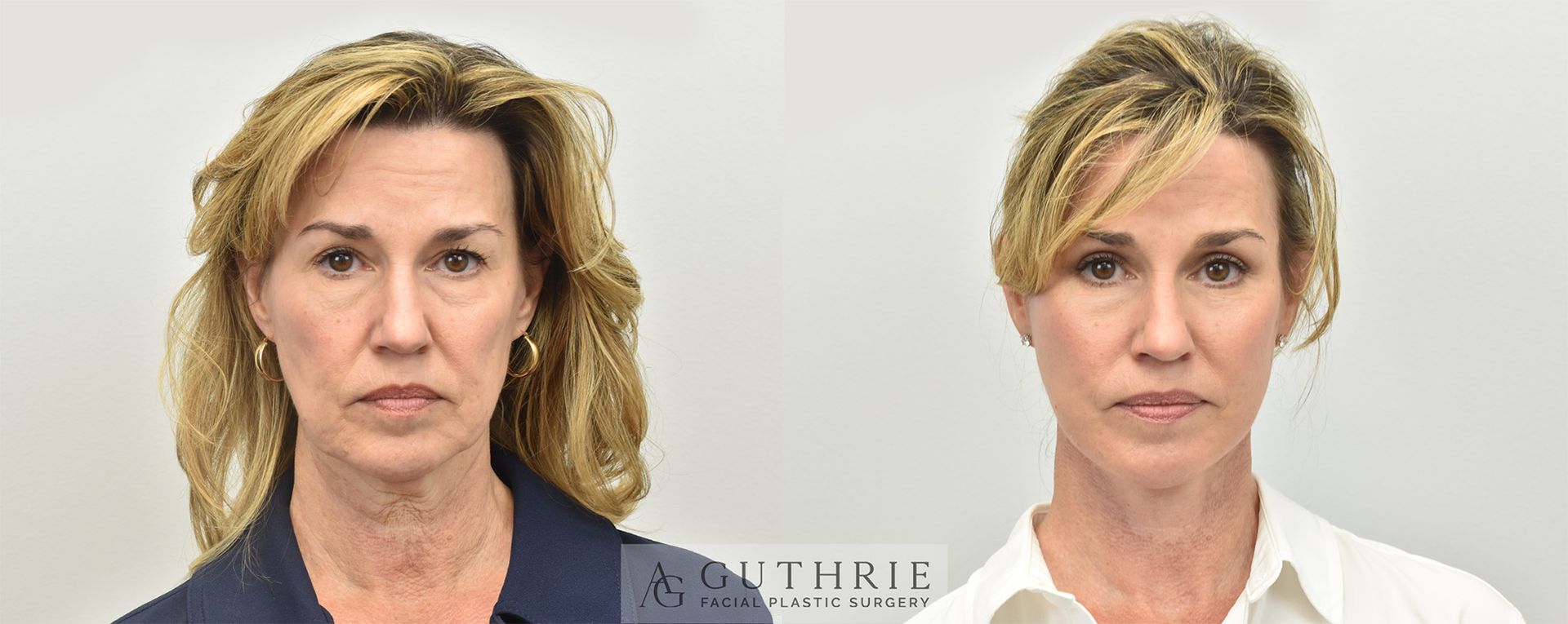 Side-by-side portrait of a woman before and after cosmetic facial treatment, with smoother skin on the right
