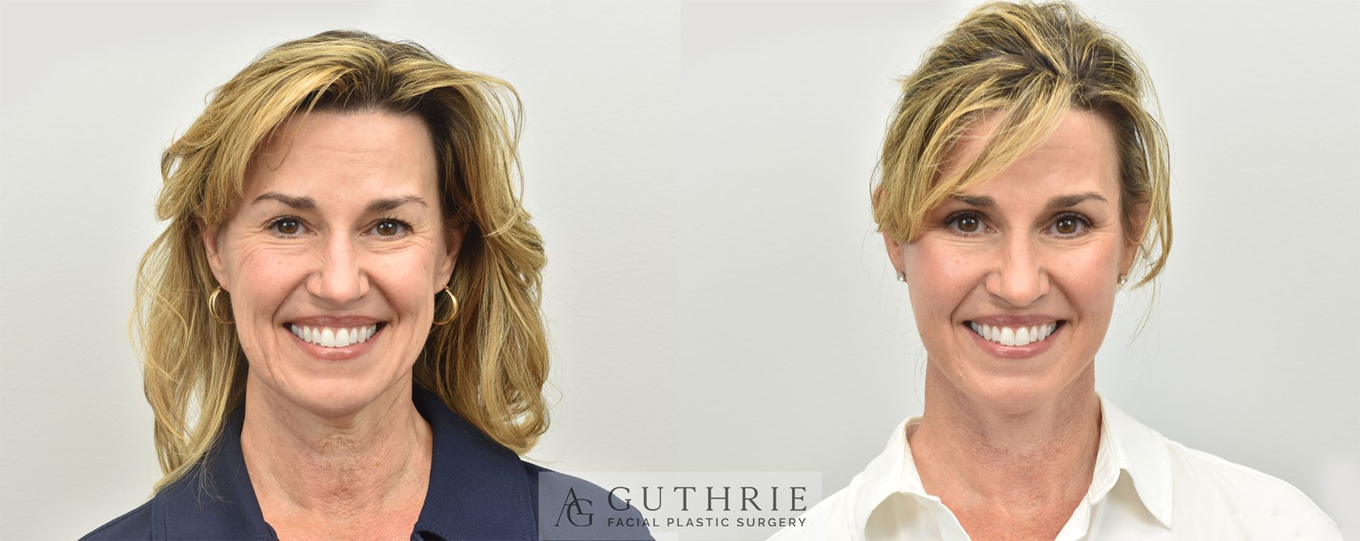 Side-by-side portrait comparison of a woman before and after cosmetic facial treatment