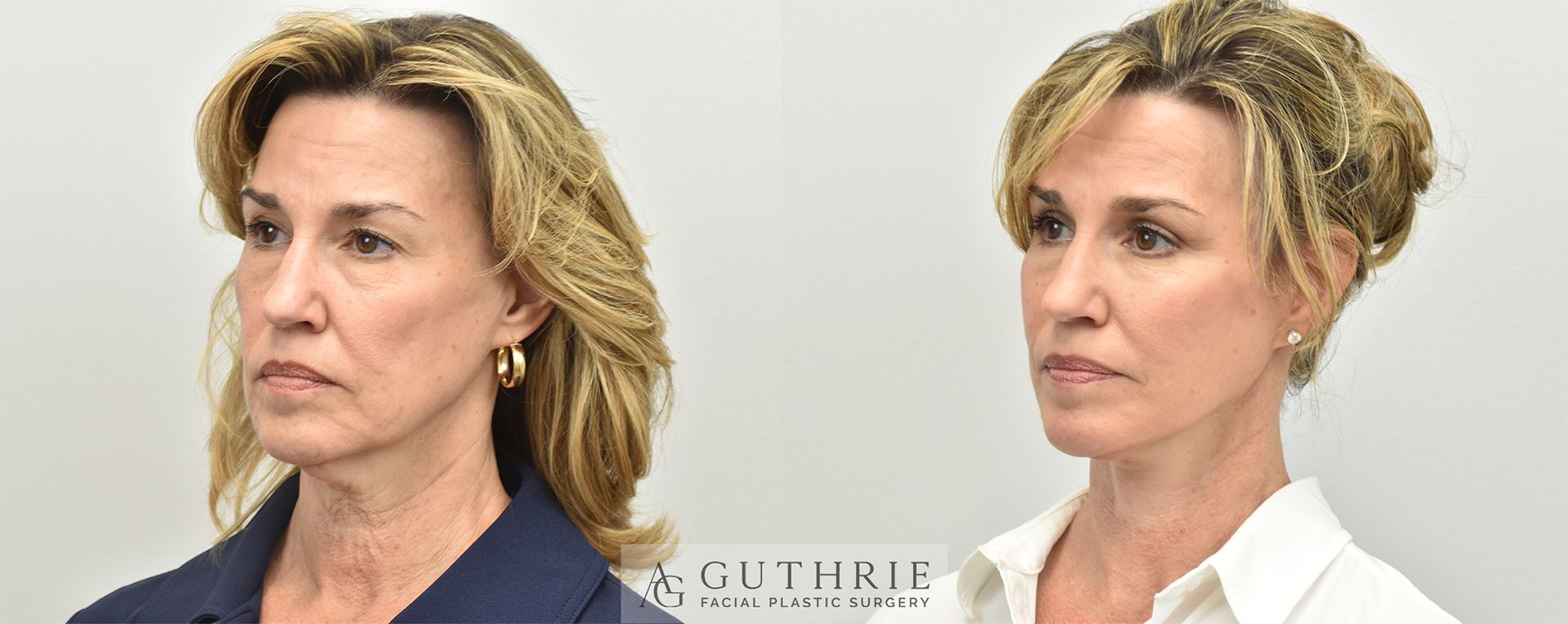 Side-by-side profile photos of a blonde woman, one in a dark top and one in a white blazer.