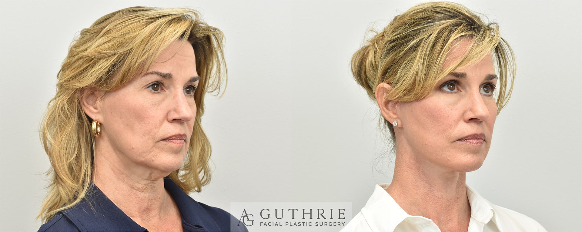 Before and After Facelift, with Upper Blepharoplasty