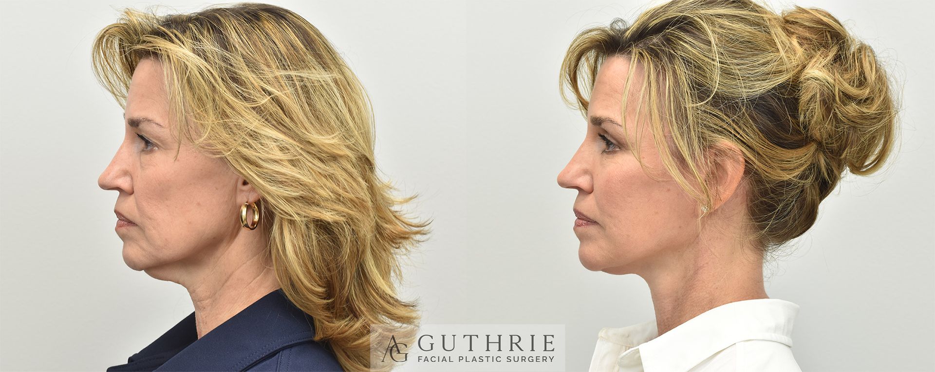 Side-by-side profile photos showing before and after a hairstyle change, blond hair loose versus pinned up.