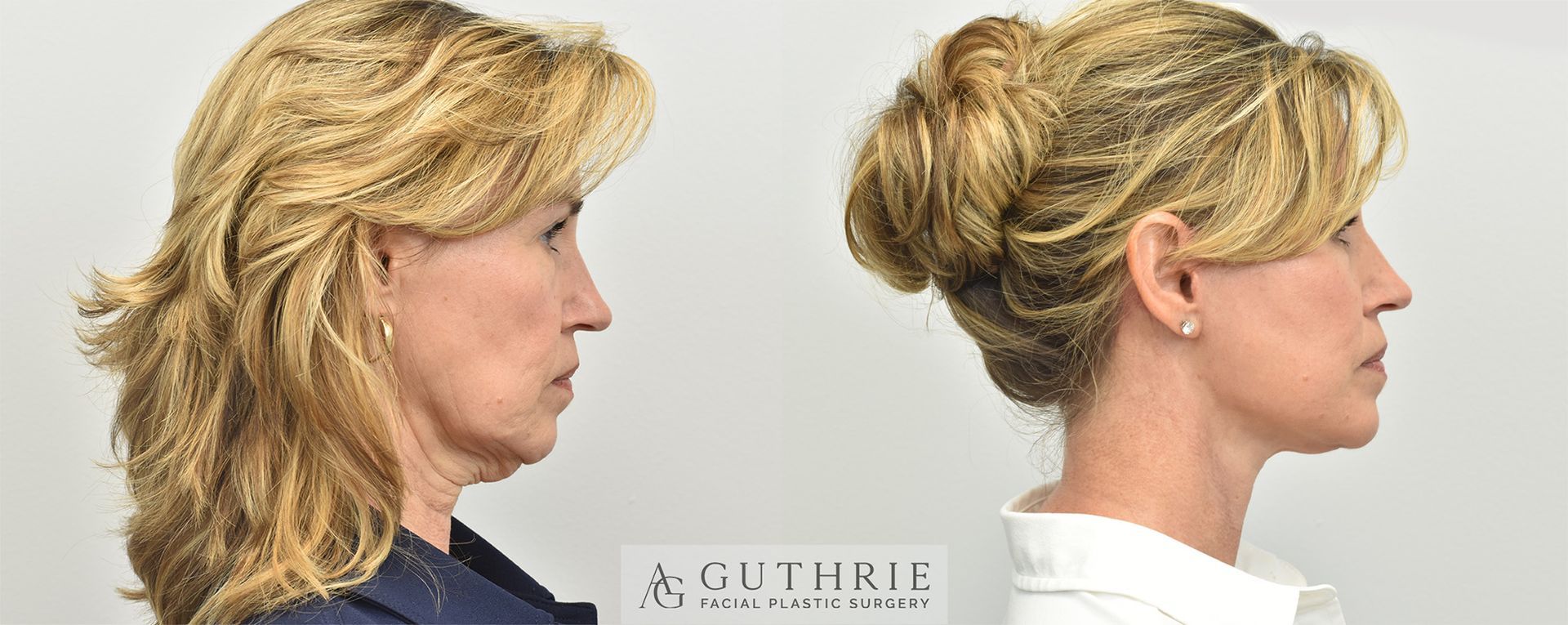 Profile views of a blonde woman’s hairstyle before and after, side-by-side on white background