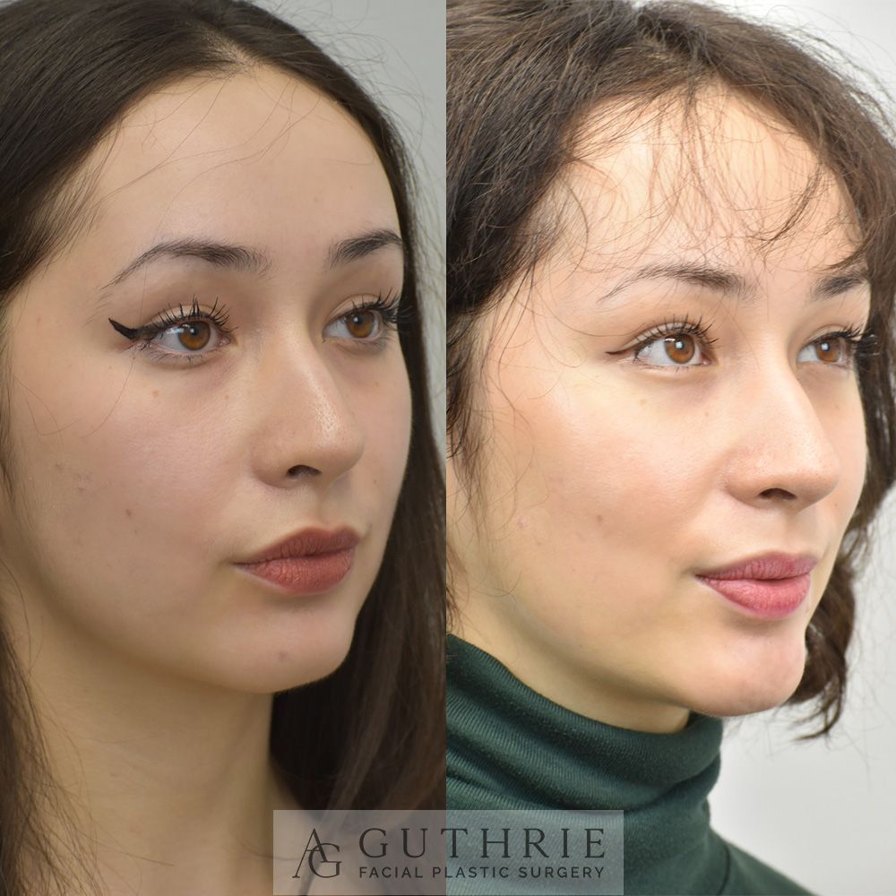 Before and After Direct Submental Liposuction
