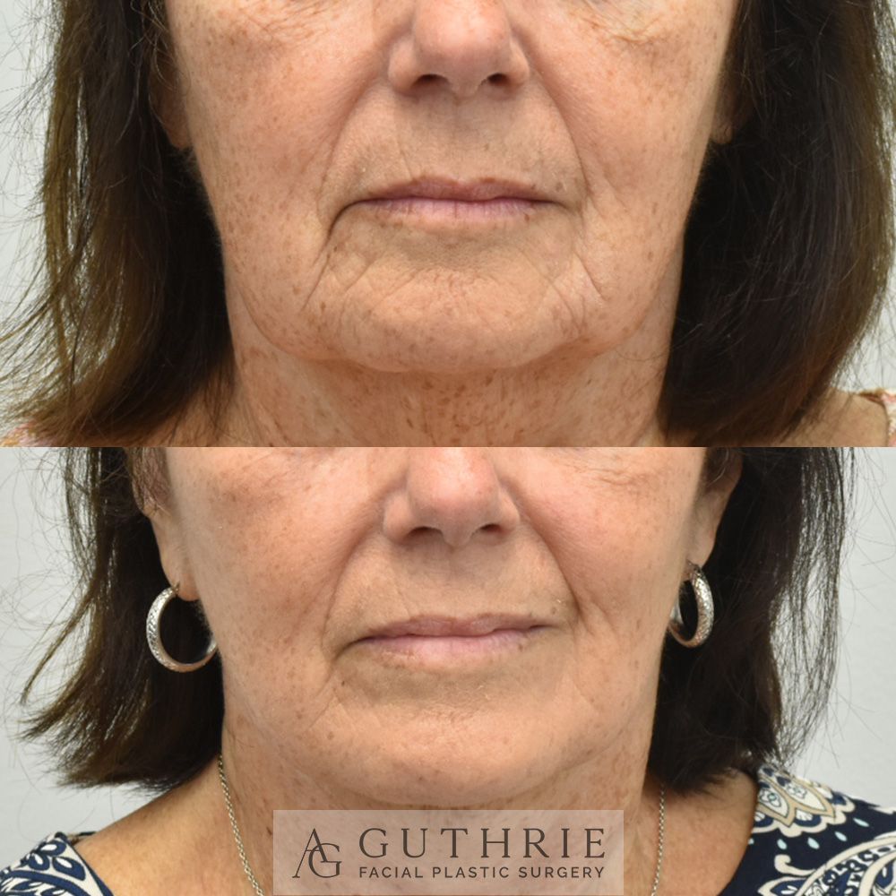 Before and After Tetra CO2 Laser Resurfacing Treatment