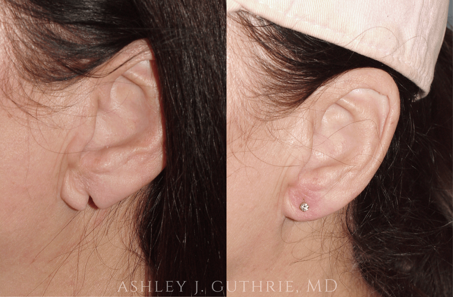Before and 6 Weeks After Earlobe Repair