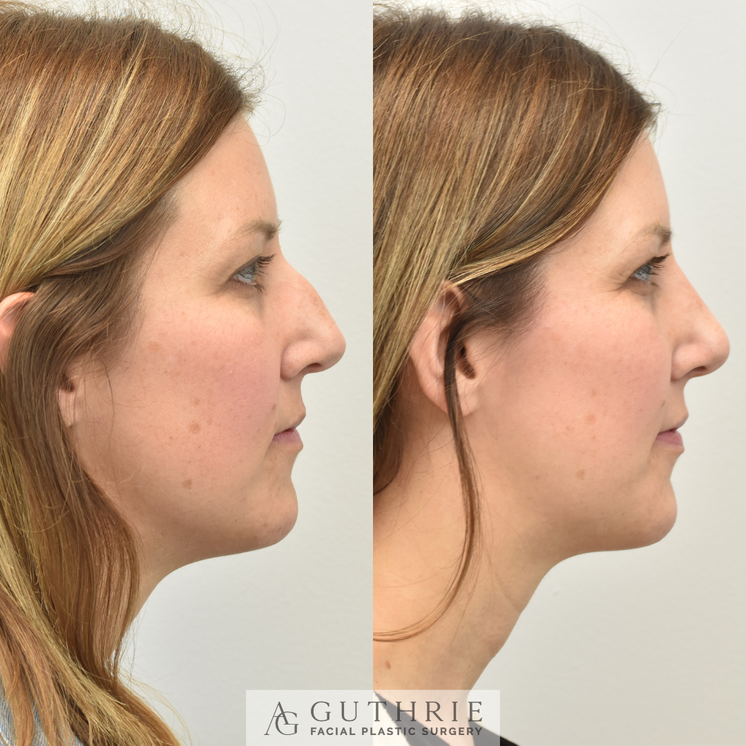 Before and After Rhinoplasty