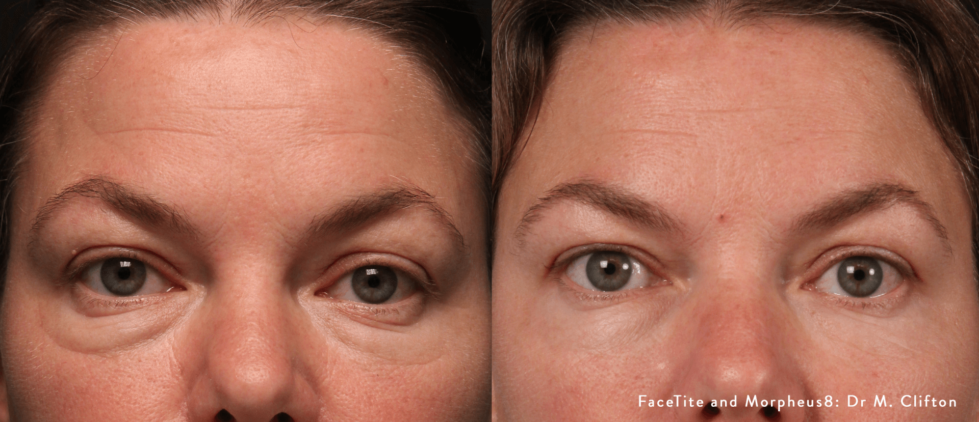 facial contouring - before and after