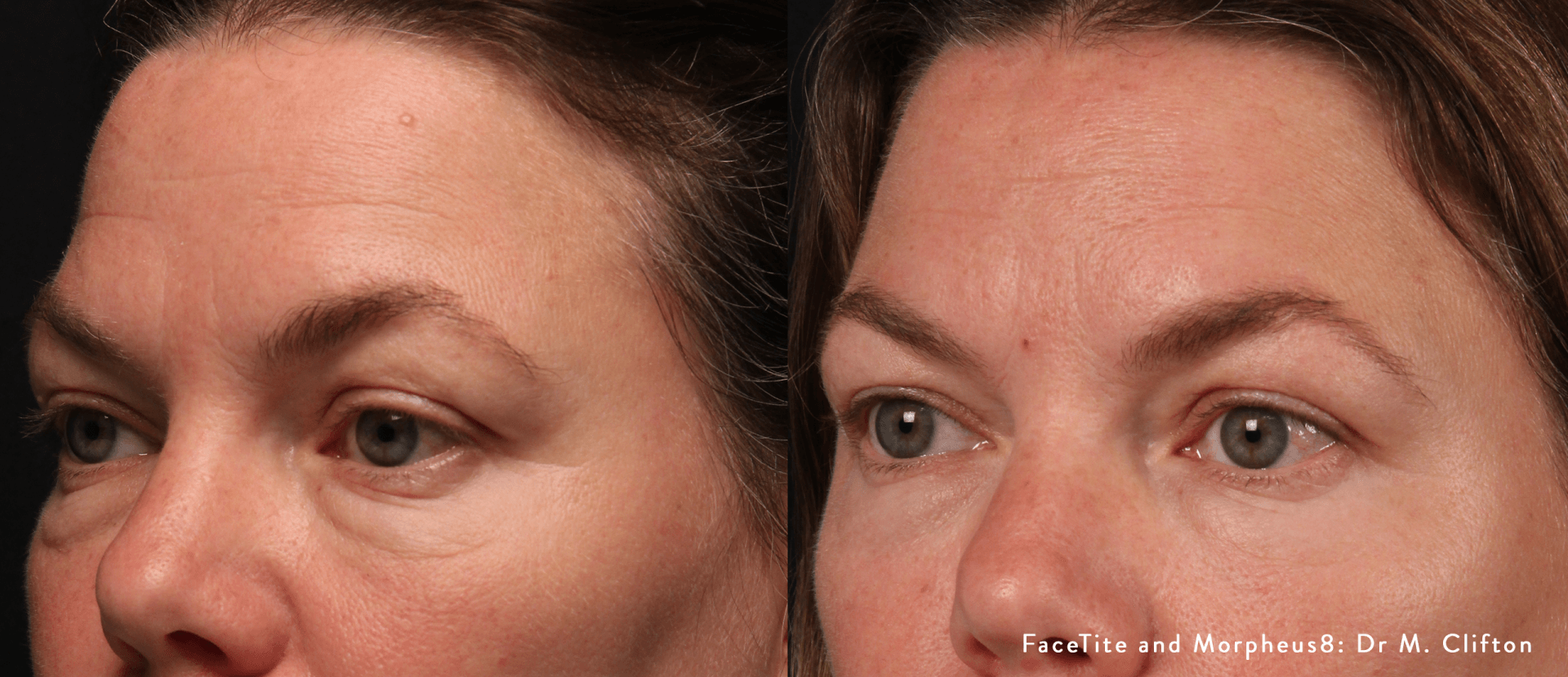 facial contouring - before and after