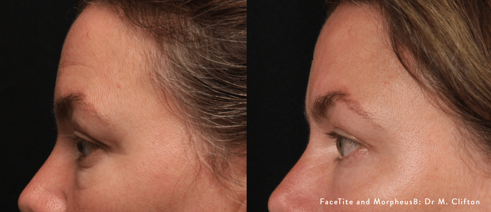 facial contouring - before and after