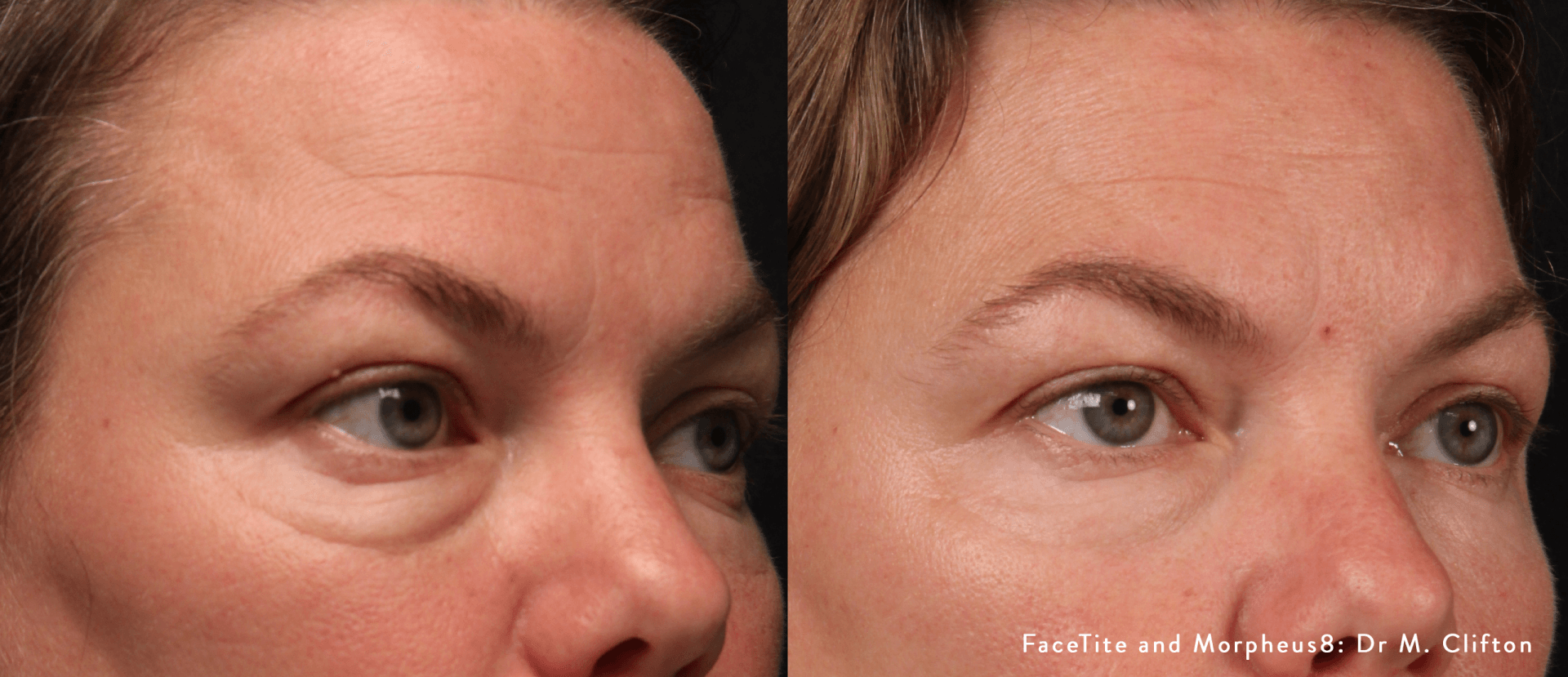facial contouring - before and after
