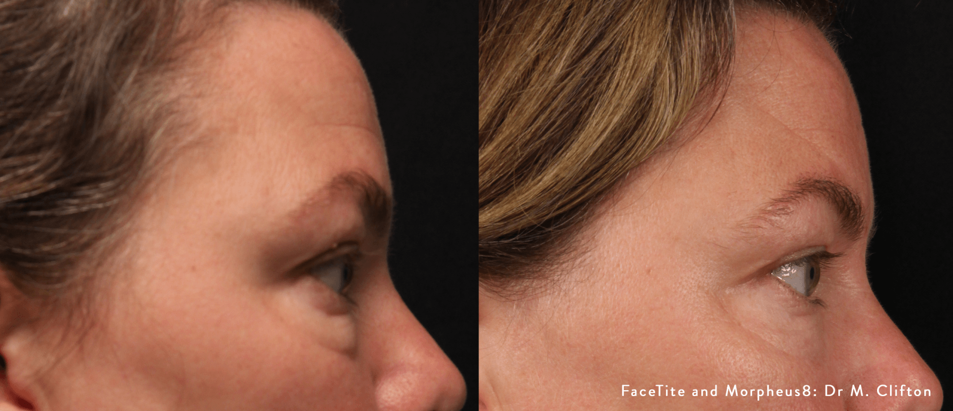 facial contouring - before and after