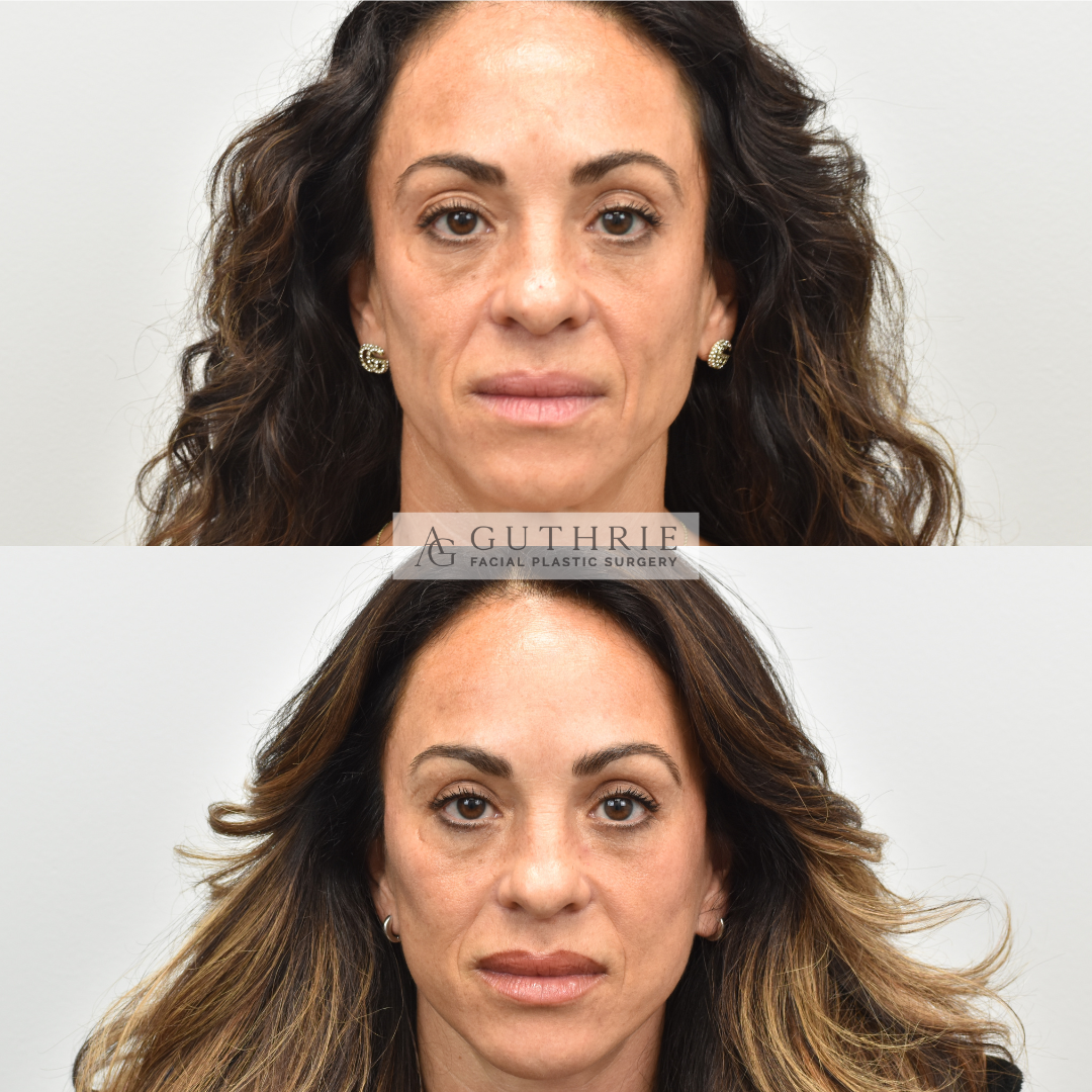 Before and After Brow Lift