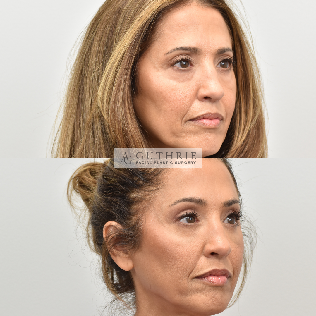 Before and After  Endoscopic Brow Lift and Lower Blepharoplasty with Fat Grafting