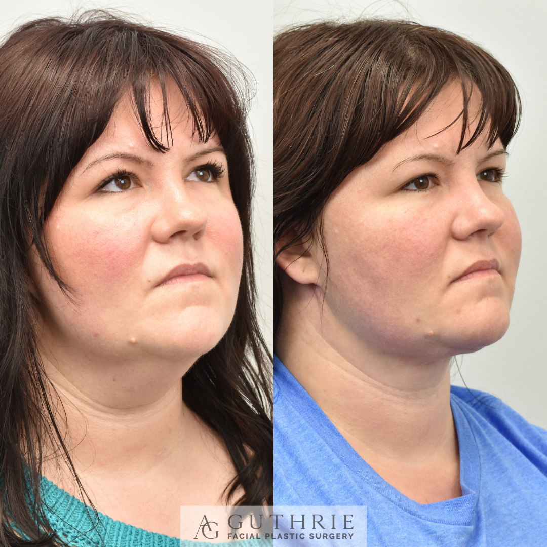 Before and After Deep Neck Lift