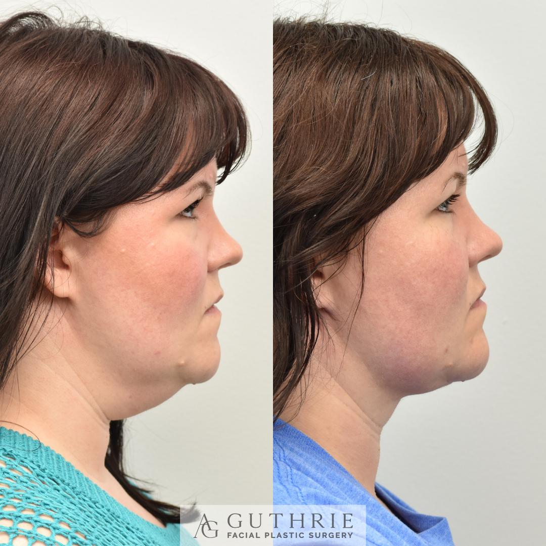 patient at guthrie facial plastic surgery before and after deep neck lift - brentwood/nashville tn
