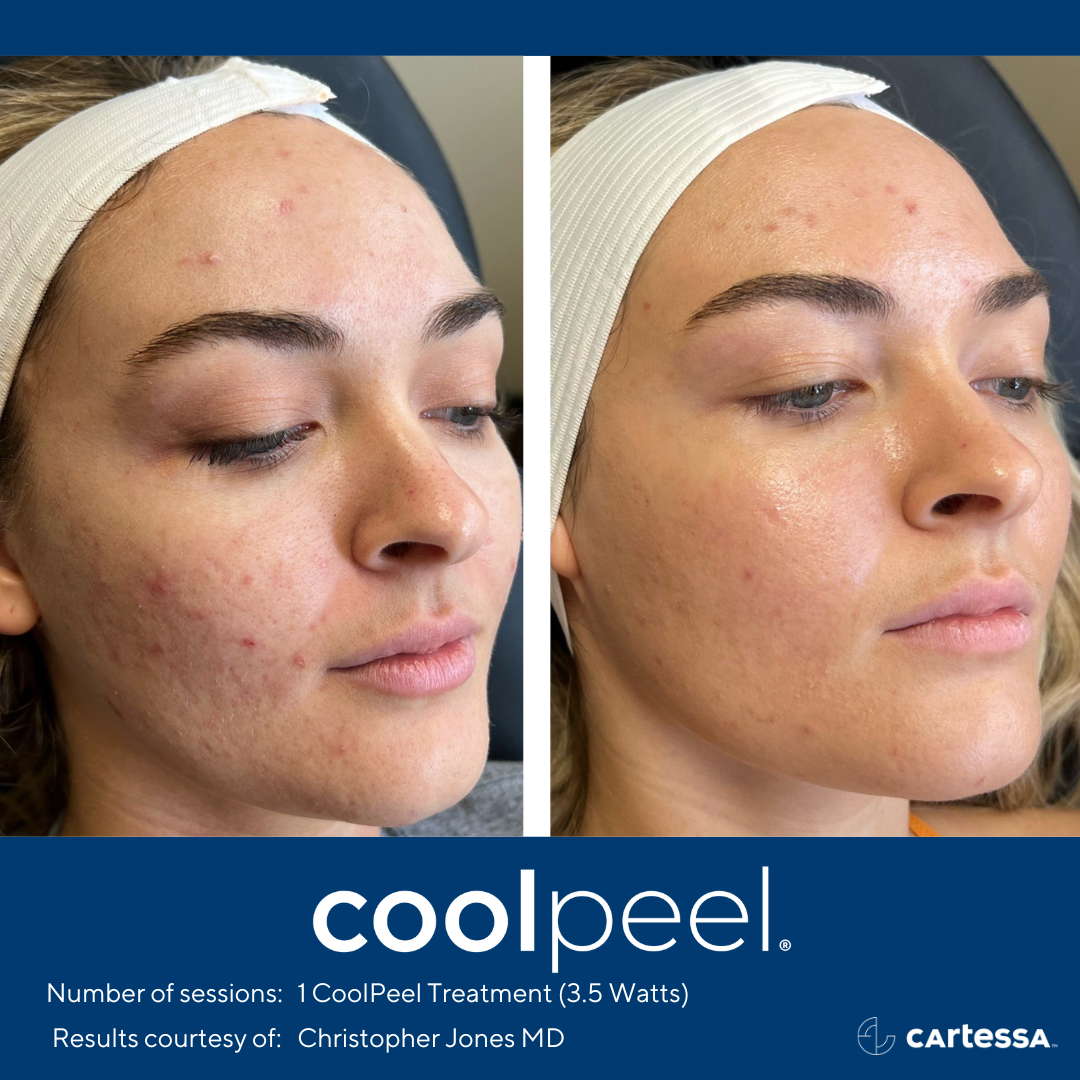 Before and After CoolPeel Laser Treatment