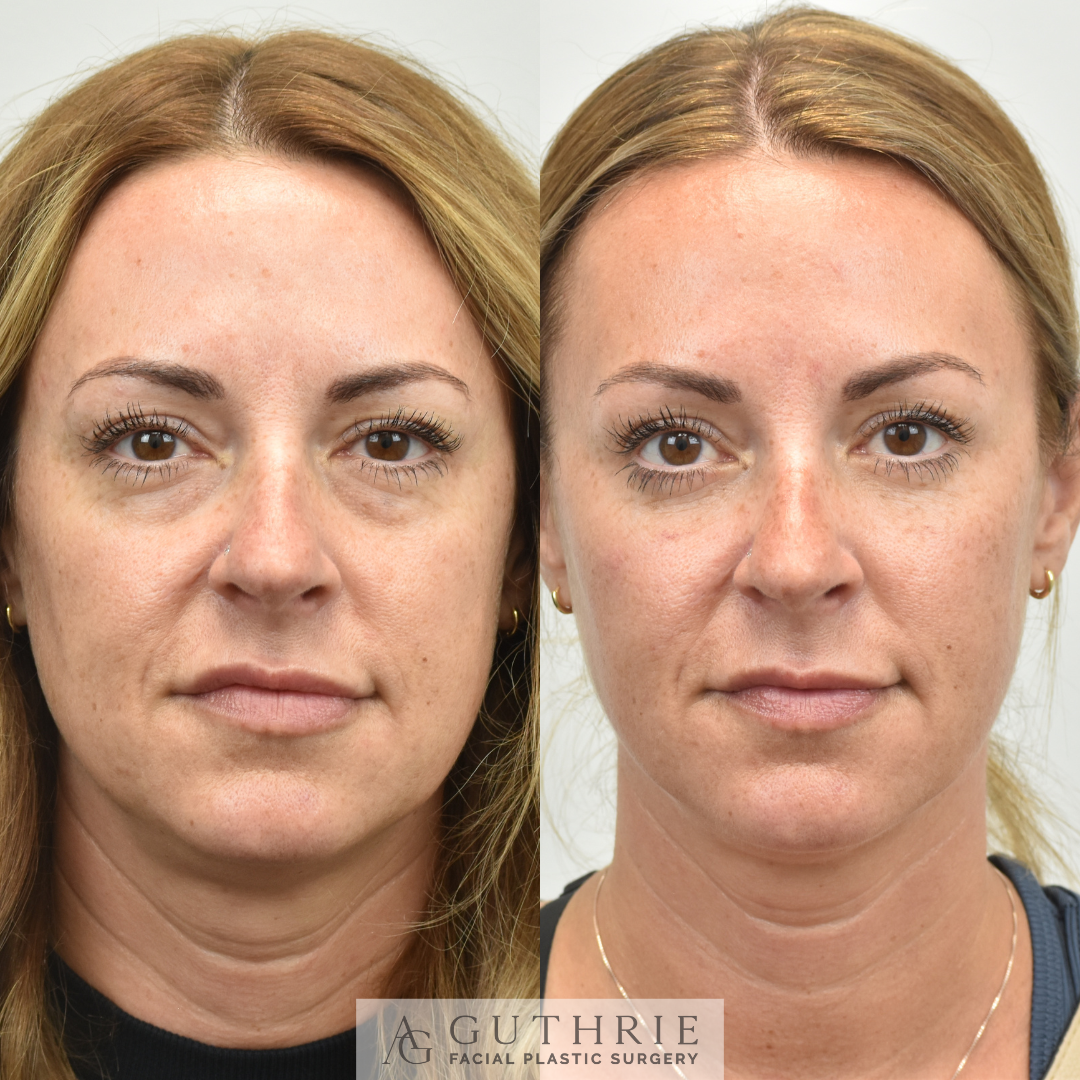 Before and After Lower Blepharoplasty with Fat Transfer