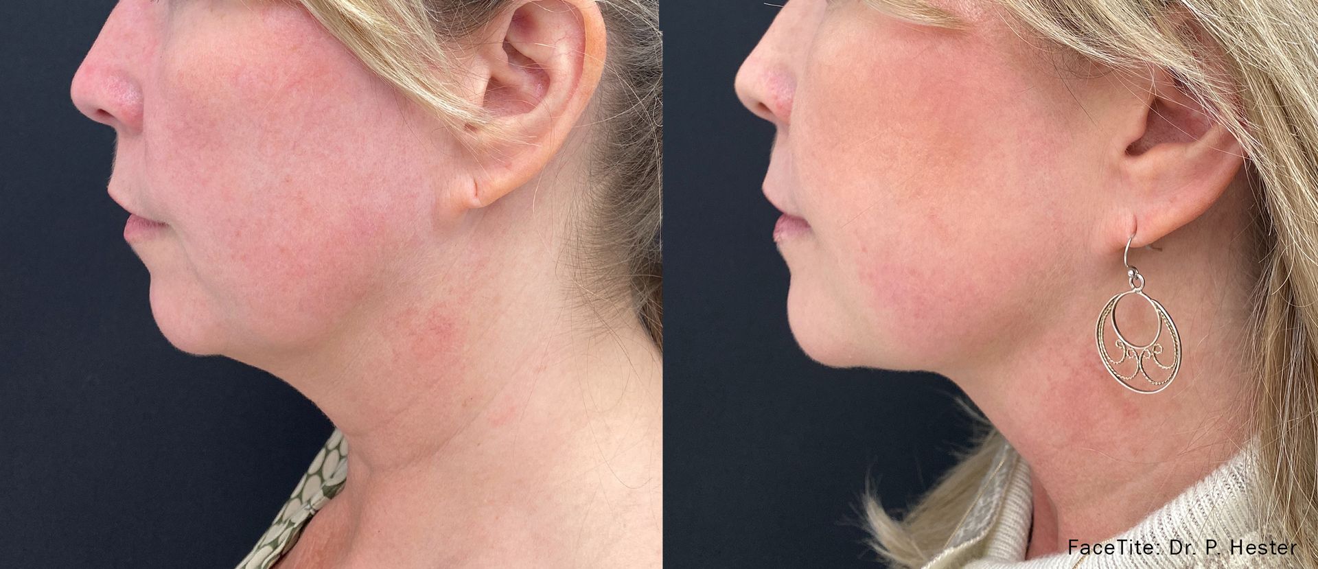 Before and After FaceTite Treatment