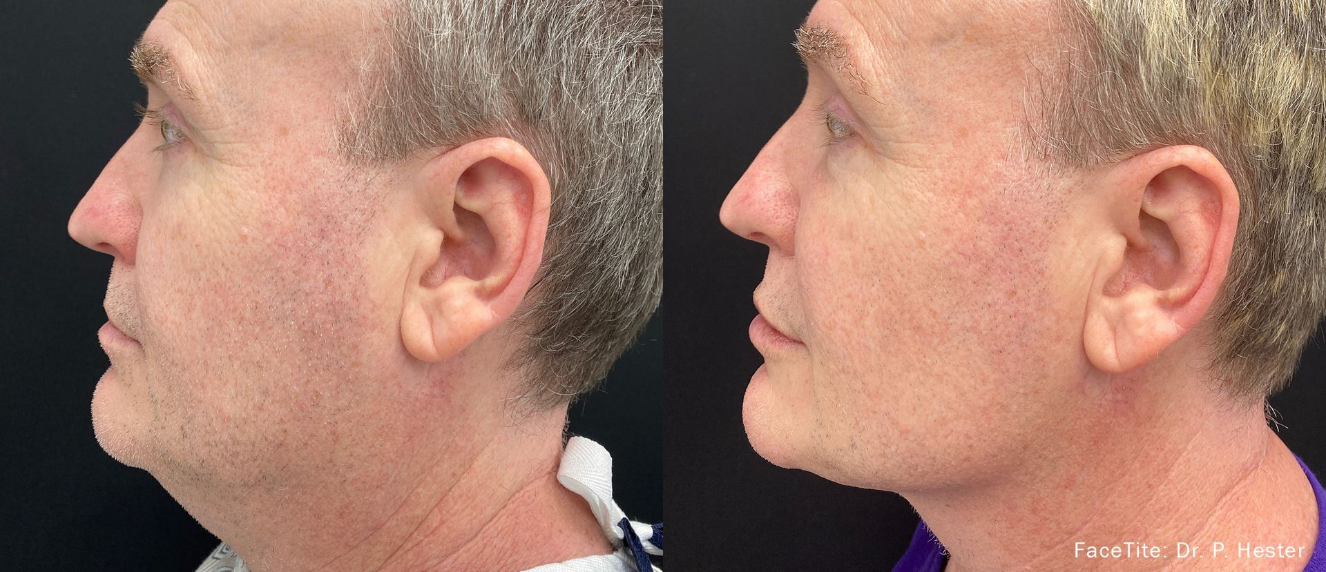 Before and After FaceTite Treatment