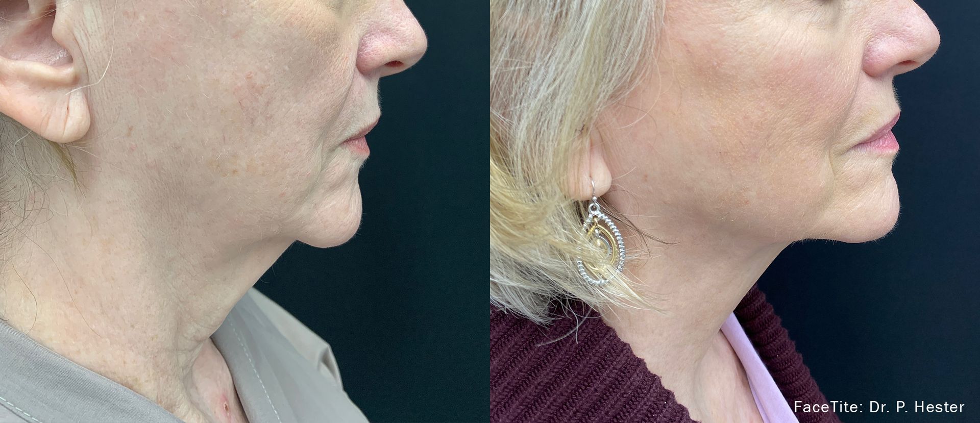 Before and After FaceTite Treatment