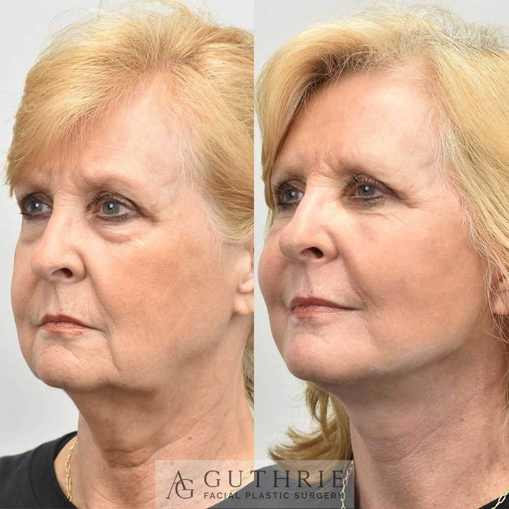 Before and After Tetra CO2 Laser Resurfacing, with Deep Plane Face and Neck Lift, Lower Blepharoplasty with Fat Repositioning, and Buccal Fat Reduction