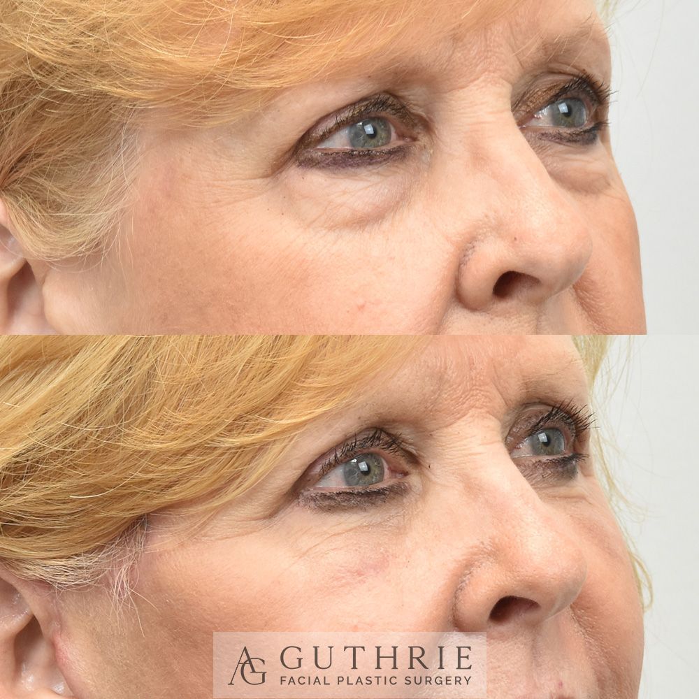 Before and After Lower Blepharoplasty with Fat Repositioning, with Deep Plane Face and Neck Lift, Buccal Fat Reduction, and CO2 Laser Resurfacing