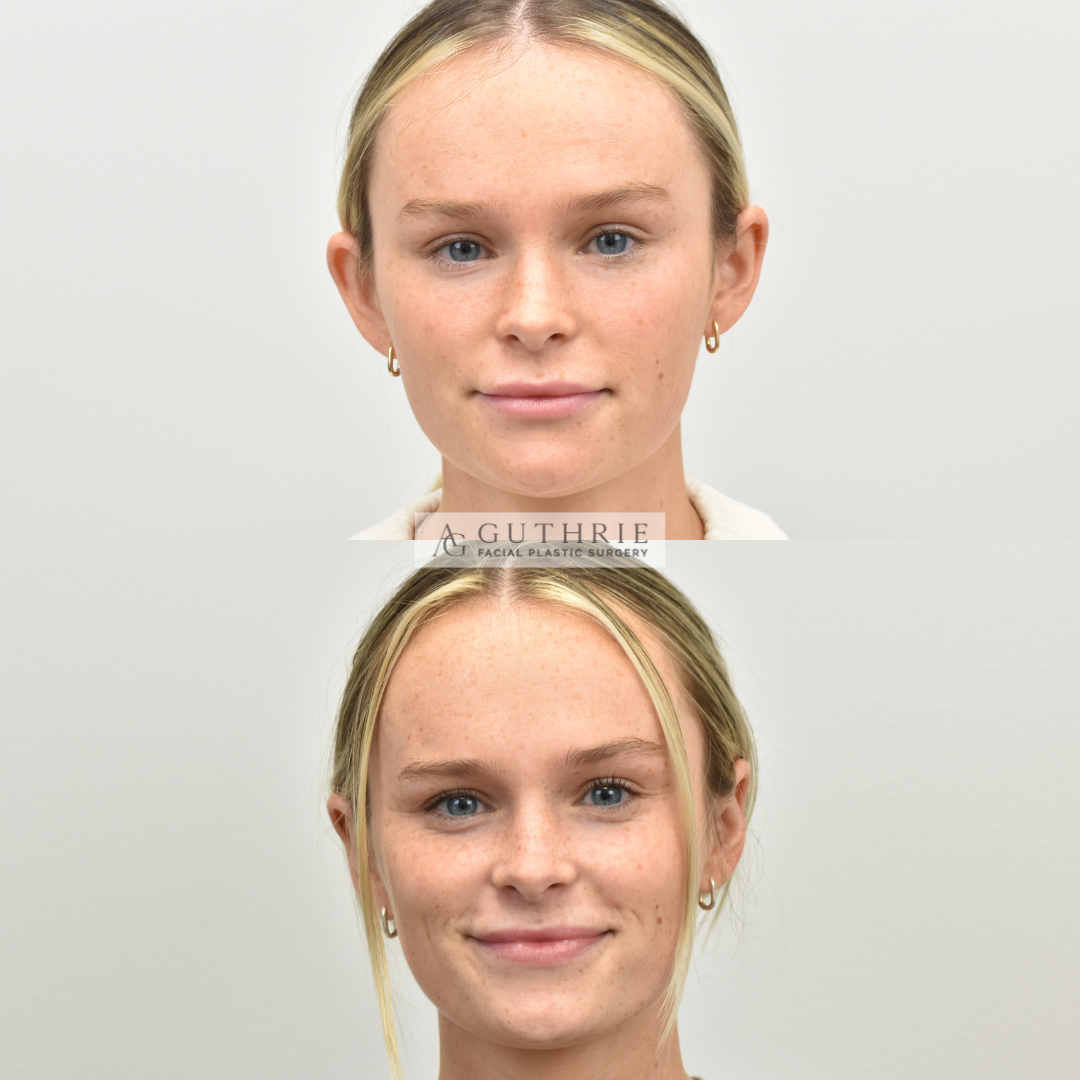 patient at Guthrie Facial Plastic Surgery in Brentwood Nashville TN before and after Otoplasty surgery for ears